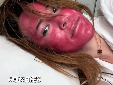 37岁女子22年不#卸妆,皮肤红成“关公脸”受损严重。#医生: #皮肤 也需要轻断食,经常化妆建议每周#素颜 一天。