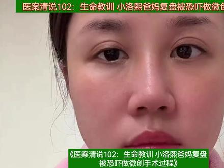 医案清说102:生命教训 小洛熙爸妈复盘被恐吓做微创手术过程 #我为小洛熙发声 #医案清说 #小洛熙爸妈复盘被恐吓做微创手术过程 #医疗纠纷律师 #医疗事故律师
过度医疗不是医疗纠纷,不仅破坏医患信任基础,而且很致命。患者信任医生没有错,医生利用家长爱子心切欺骗手术需严禁。
大家好,这里是天斗医号患者权利保护组,患方依法维权理论策略中心。我是北京的医疗纠纷律师宋中清。
宁波5个月女婴小洛熙因一场“微创”心脏手术离世,家属指控医生利用家长信任夸大病情、隐瞒术中致命失误,引发全网对医疗伦理与制度漏洞的追问。
一、核心事件经过
术前误导与施压
早产儿小洛熙体检发现房间隔缺损(3mm+7mm),涉事医生陈某贤(宁波妇儿医院心胸外科主任)告知家属“自愈概率极低”,称延迟手术会导致“发育迟缓、智力受损甚至死亡”。承诺手术为“腋下微创”,耗时仅2.5-3小时、成功率99%。家属在“权威医院+主任医师”双重信任下同意手术。
术中重大失误与隐瞒
操作事故:手术原定微创却转为开胸+体外循环(心脏停跳),因首次缝合失误导致肺静脉阻塞(缝死血管),被迫二次开胸抢救。
超时隐瞒:手术长达7小时(超时3倍),家属4次致电询问进展,仅获“稍有难度”的模糊回应,未被告知抢救实情。
证据矛盾:麻醉记录显示11:05已出现肺出血(气管喷血性液体),但医院直至16:37才推出患儿,并谎称“手术成功”。
术后抢救与死亡争议
患儿出手术室时全身发紫、眼角含泪、嘴角未闭,转入PICU后持续抢救未通知家属。
病历记载22:08“生命体征平稳”,但22:03宣告死亡,时间矛盾。院方以“家属情绪激动”为由拒绝母亲见最后一面,直至凌晨才允许隔门对话。
二、医疗过程关键违规点
手术必要性存疑
医学共识指出,早产儿房间隔缺损小于5mm可观察至1岁,多数自愈。涉事医生未建议观察期,反而施压立即手术。
严重程序违法
知情权侵犯:未告知手术方案变更(微创转开胸)、二次开胸抢救、病危状态。
病历篡改:死亡时间记录矛盾,未在抢救后6小时内补录病历(违反《医疗纠纷预防和处理条例》)。
监控隐匿:医院拒绝提供手术室及ICU监控视频,卫健委称“无全程录像”。
医生资质与历史问题
陈某贤原为泌尿科医生,转型心胸外科仅1年,被曝2025年6月同类手术致1岁患儿死亡。
术前检查缺失:复杂型缺损需做增强CT/MR确认血管路径,仅凭B超仓促手术。