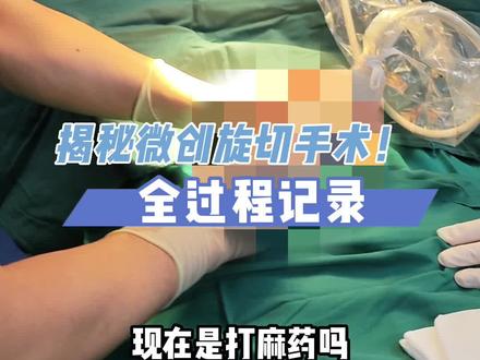 乳腺结节微创旋切手术全过程!#乳腺结节 #乳腺结节微创手术 #乳腺结节三类