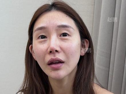 比起被说科技脸,更不想被喊老阿姨~ 个人效果差异,出镜人已签署相关肖像授权,此视频不宣导任何风险医疗项目!出镜人已满25周岁!#面部提升三件套#法令纹怎么消除#面部提升#抗衰老#变美