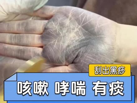 咳嗽 哮喘 有痰 刮痧刮出黑包 淤堵太多 #抖出健康知识宝藏 #我的年度健康知识盘点 #刮痧#哮喘 #咳嗽