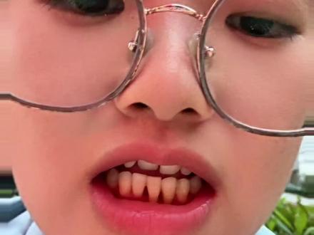 牙齿固定两天了,好处是牙齿不松了#牙周炎