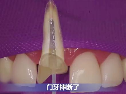 #门牙断了怎么办,别担心,还能补!#口腔科普 #拔牙 #种牙 #补牙