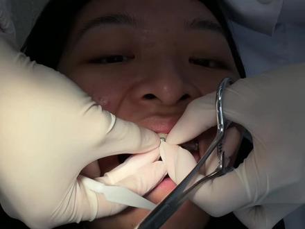戴牙套前知道这五件事,我得少吃多少苦啊...以身入局,恨自己没有早点知道的事情分享给牙套搭子们,希望我们都有一口美美的好🦷#牙齿正畸 #牙套 #钢牙妹 #带牙套牙套的日子 #牙套日记