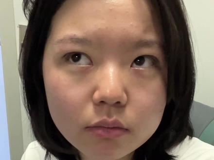 双眼皮初体验也是分享上了!
#双眼皮 #埋线双眼皮效果 #vlog #经验分享 #单眼皮