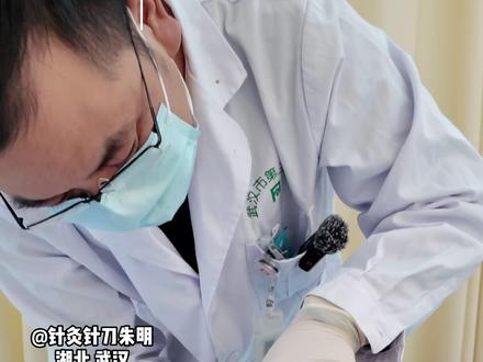 急性期肩袖损伤,睡觉翻身都疼,胳膊抬不起来,针刀松解好多了 #肩袖损伤#肩颈疼痛#中医针灸#中医朱明#中医针刀