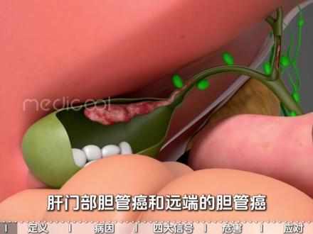 癌王之王胆管癌,5年生存率不足10%,早筛才能救命 #抖出健康知识宝藏 #胆管癌 #癌王之王 #肿瘤科普 #防癌早筛