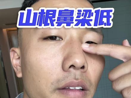 山根鼻梁低,软组织版#面部提升