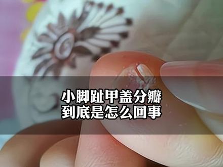 你的小脚趾甲盖是整体一片还是分开的?这是什么特征呢?#趾甲 #迁民 #汉族