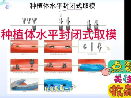种植体水平封闭式取模 #热点种牙已经很普遍了,那么应该如何取模?开窗还是闭口?上个视频有开窗式的#牙科诊所 #牙齿