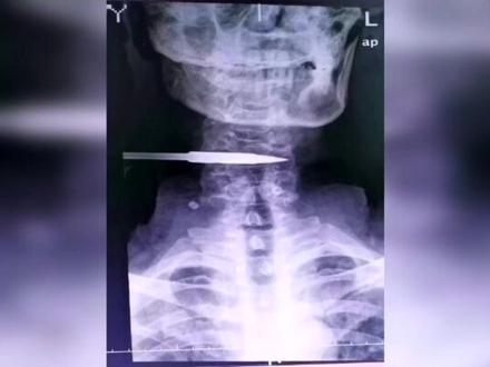鱼镖跑偏射入颈部,真是命大福大!#捕鱼 #钓鱼 #飞镖