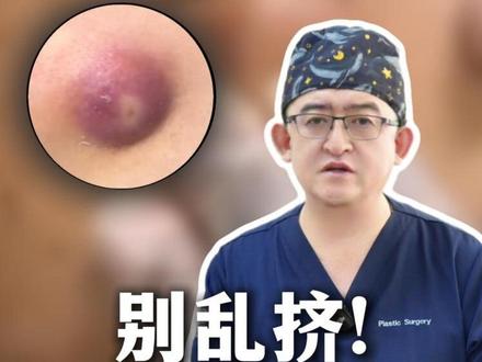 皮脂腺囊肿,千万别乱挤!#皮脂腺囊肿 #皮脂腺囊肿怎么消除 #整形外科 #姜兴超