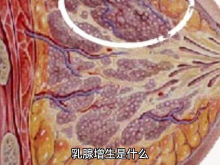 乳腺增生是什么#健康科普3000问 @小荷医典 @小荷医典官方账号
