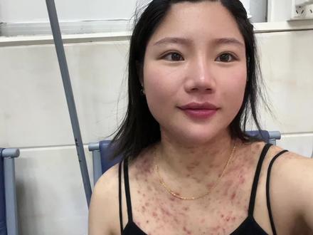 希望更多人能认识到毛囊炎,不要一看到这密密麻麻的痘痘就说az…