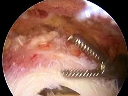 肩袖撕裂怎么修复? #医学科普