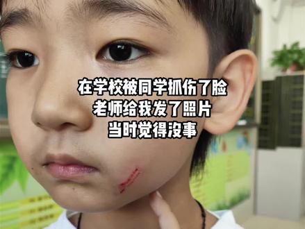 上学的时候脸被同学抓破了,今天去美容科打了激光,希望你能恢复正常#有一种疼叫做看着都疼 #勇敢的宝宝 #抓伤 #祛疤痕 #小孩受伤留疤怎么办