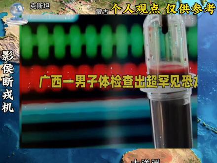 比熊猫血稀1万倍!广西男子查出的恐龙血#新闻热点#国际局势#广西全球唯一恐龙血 #类孟买血型 #全球仅2例稀有血型