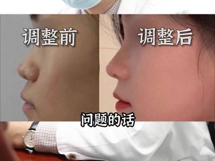 中面部重塑,月亮脸成功逆袭!#隆鼻 #鼻整形 #面部提升 #肋软骨隆鼻 #鼻基底填充