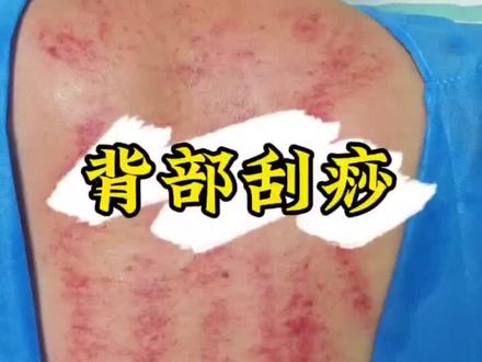 妇一科中医特色技术之背部刮痧#刮痧#中医特色技术