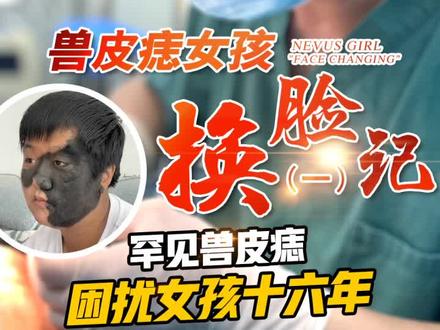 今日分享:兽皮痣女孩救助纪实(换脸记一)#整形#胎记#兽皮痣 #黑毛痣