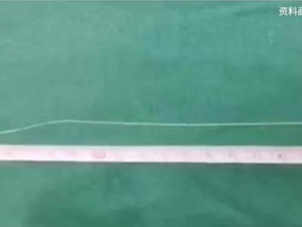 疑因喝生水感染裂头蚴,女子瘦20斤脑内取出27厘米长活虫