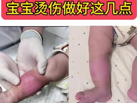 宝宝烫伤做好这几点,留疤几率大大减少! 本次烫伤原因:
1、没有将家里的热水器温度设定在安全范围内(40-50度),导致水温过高
烫伤后紧急处理‼️:
2、立即降温:冲水20分钟以上;(不要涂抹任何牙膏、酱油等偏方;避免加重感染);
3、轻微红肿无破皮,可以线上购买美宝烫伤膏;冲完水发现有破皮红肿的情况,不要犹豫直接送往儿童医院挂急诊处理,路程远的备2条小方巾,轮流用冷水给烫伤处降温,缓解疼痛;(普通医院诊所是不给看的,尤其是小月龄宝宝的,我当时就跑了三个医院,耽误了将近两个小时)
包扎护理:
4、包扎期间切记!一定不要碰水!避免感染!
5、保证宝宝营养,奶量充足睡眠充足,最好能睡整觉,这样恢复起来快;
6、穿衣服尽量宽松舒适的,不要穿太多,在家穿睡衣最好;
7、破皮且烫伤比较严重的,会有掉皮情况,不要徒手撕掉,让它自然脱落,一定不要让宝宝抓挠,每天可以涂抹2遍身体乳(我自用的是大白罐,中午和晚上各一次),保持皮肤湿润,减少疤痕;
8、在完全好之前避免烫伤处晒太阳,出门可以穿宽松的袜子;
9、家里可以常备烫伤膏药(美宝烫伤膏,人表皮生长因子);#处理烧烫伤的注意事项 #烧伤烫伤的应急处理方法 #小孩被开水烫到了怎么办
