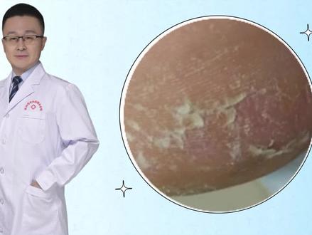 脚后跟粗糙、干燥怎么办?这个方法来拯救#脚气#角化型脚气#医学科普#脱皮#皮肤