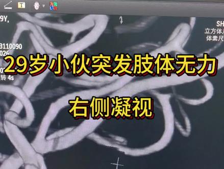 29岁青年突然偏瘫,脑血管造影正着看没事,一翻转吓一跳。#脑血管造影#青年卒中#大脑中动脉狭窄#急性脑梗死