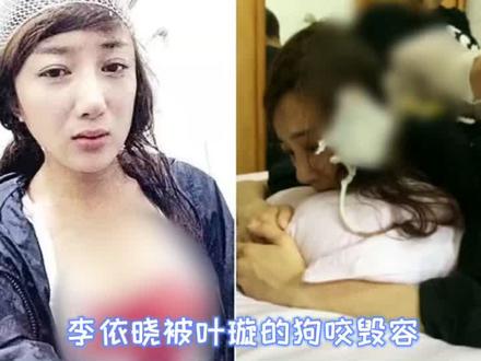 #叶璇 #李依晓 应大家的要求,这就是叶璇的狗将演员咬毁容事件