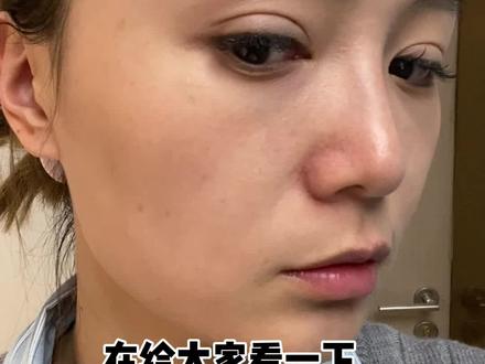 超声炮记录反馈来啦#护肤 #超声炮 #变美