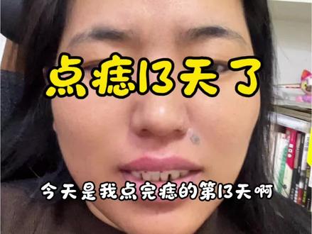 有人问我怎么点点痣,花多少钱,想知道的看过来#点痣