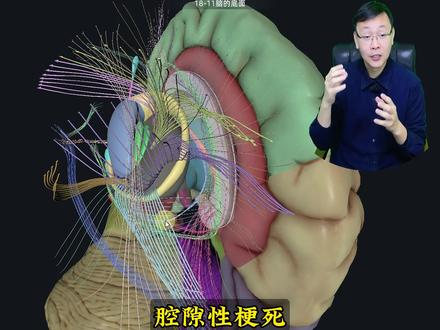 腔隙性脑梗死,严重吗?需要治疗吗?从大体到微观给您讲清楚 #腔隙性脑梗死 #脑梗死 #脑出血 #抖出健康知识宝藏 #我的年度健康盘点