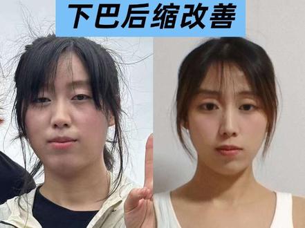 方圆脸,下巴后缩瘦脸分享!
#瘦脸 #方圆脸瘦脸 #下巴后缩 #瘦下巴瘦脸 #练背