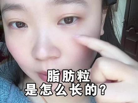 脂肪粒是怎么形成的#种草 #养肤 #护肤