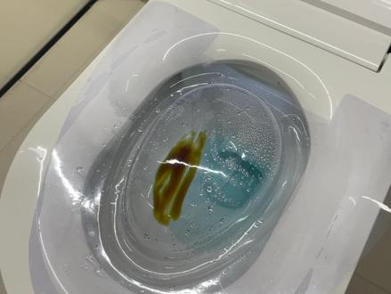 智能马桶的臀洗妇洗有多脏😷
买了智能马桶,但不敢用臀洗妇洗功能…
智能马桶真的能洗干净PP吗?
只要水压和冲洗位置调整合适,水洗肯定比纸巾擦拭得干净。
⭕因为如果用纸巾擦拭,一般擦到颜色很浅的时候,就结束了;
🖤智能马桶冲洗则不一样,宽幅水流会反复冲洗臀部周边区域,持续且有力度的热水能溶解软化污物,并冲刷掉臀部上纸巾擦拭时容易遗漏的区域。
清洗过程中需要用到纸巾吗?
需要的。
⭕虽然智能马桶都配置了暖风烘干功能,但事实上绝大多数产品的暖风烘干功能其风力和温度,并不能迅速吹走附着在臀部上的水滴;
🖤所以,臀洗过后,建议先用纸巾将臀部上的水滴带走,再使用暖风烘干会更快捷。
臀洗、妇洗、移动清洗有什么区别呢?
拿这款智能马桶为例:
🌈移动清洗:是需要配合妇洗和臀洗的,如果选择了妇洗再选择移动清洗,那么就能实现移动着妇洗的需求;
🌈妇洗:在喷水杆中臀洗和洗妇,有不同的水路和喷水孔,一定程度上避免了交叉感染。臀洗用于清理PP上的脏物,而妇洗用于清理女性的私处,水压更加温柔,配备了宽幅强洗和移动清洗,清洗面积更广,专用女生所设计,贴心且实用;
⭕妇洗和臀洗水温、水压、喷杆位置都能根据自身的需要进行调整 #智能马桶 #马桶 #卫生间好物 #跟着抖音学装修 #好物推荐🔥 @抖音小助手 @抖音创作小助手