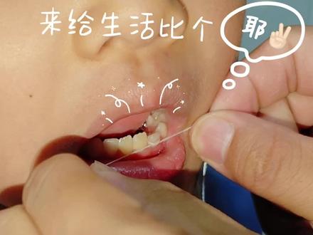 儿童换牙拔牙。祺祺的第三颗牙齿。#拔牙 #儿童拔牙