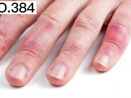 手被冻得又痛又痒,别再泡辣椒水了,教你正确处理!#冻疮 #护手 #科普