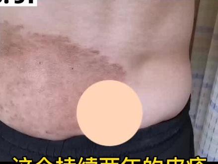 患者错把体癣当湿疹,难怪两年多还没好,体癣应该怎么治?#体癣 #股藓 #湿疹 #医学科普 #健康科普