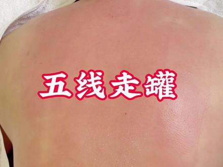 四分钟学会拔罐,让家人一起健健康康#拔罐#拔罐养生