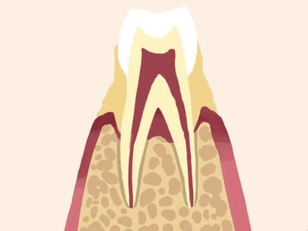 外伤引起儿童牙齿松动怎么办?#口腔健康 #儿童牙齿 #宝妈 #带娃注意事项 @DOU+小助手