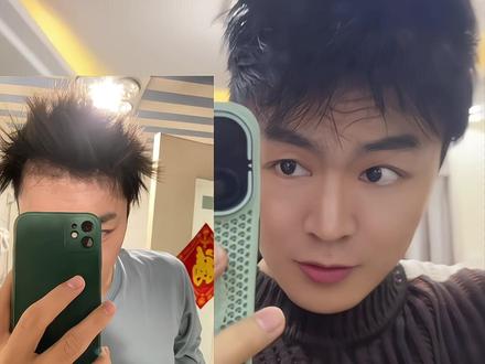 2021-2026五年养发计划取得阶段性胜利🙋 所以关于头发的内服到底应该吃什么?鱼油?生物素?#养发护发的小窍门推荐 #植发的人后来怎样了 #生物素 #头发护理