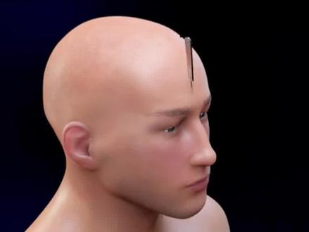 3D演示开颅手术#手术 #科普 #3d动画#知识科普#健康@抖音小助手