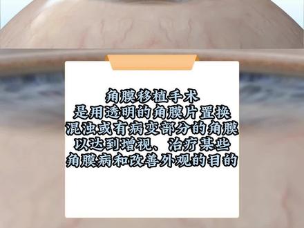 角膜移植3D动画演示#角膜移植 #角膜移植手术