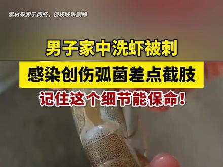 做饭手指被鱼虾扎伤,千万别不当回事!当心感染截肢!医生教你3步处理法 #海洋创伤弧菌 #鱼虾扎伤 #海鲜 #医学科普 #抖出健康知识宝藏