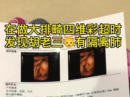 这就是你们的胡老三要做的手术,叫隔离肺#人类幼崽成长计划 #隔离肺