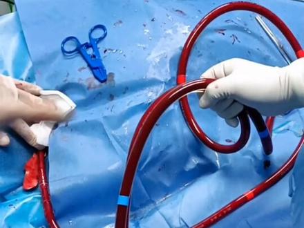 当血液引出经过救命神器ecmo再回到身体的那刻,希望来了!愿所有人都用不到#ecmo #现场实拍 #护士 #快点好起来