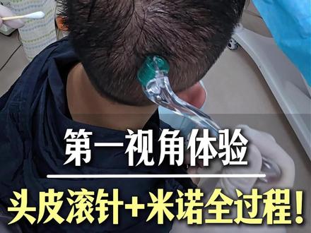 带你沉浸式体验:头皮滚针➕米诺全过程~ #脱发 #头皮滚针 #米诺地尔酊 #头皮护理 #广州郭镇合