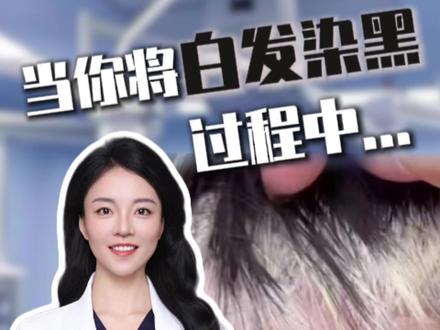 当你将白发染黑,不可逆的情况就出现了 #白发转黑 #染发 #脱发 #雄脱#毛发医生王艳阳