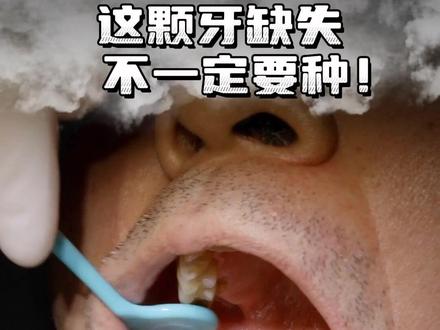 这颗牙缺失不一定要种! #种植牙 #种牙