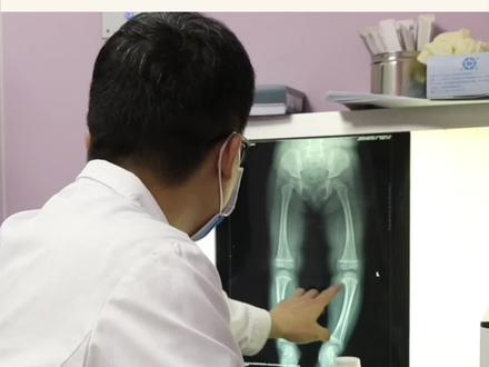 什么样的O型腿必须手术矫正?#医学科普 #O型腿